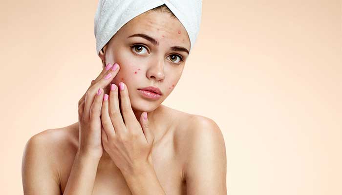 Acne issue