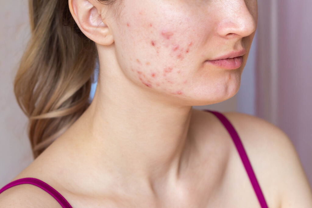 Acne Vulgaris