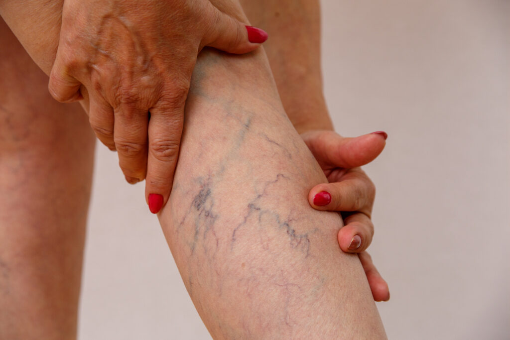 treat eczema and dermatitis with homeopathy