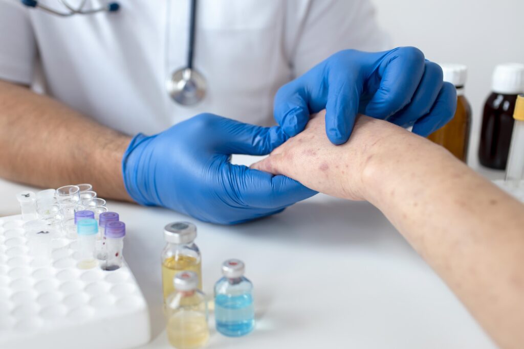 treatment of eczema and dermatitis